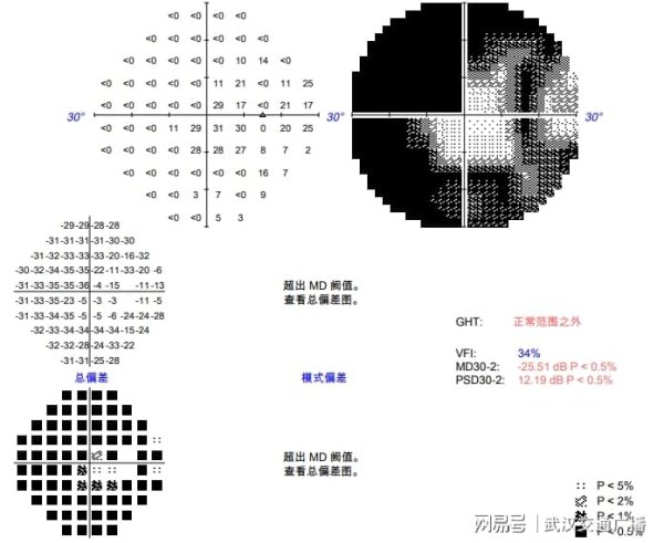 盛金缘证券 视力骤降竟是青光眼作祟？女子就医方知眼压已飙升数倍！